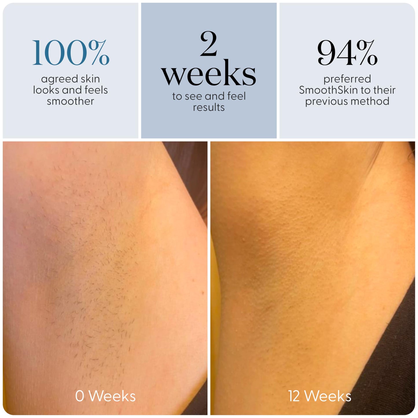 SmoothSkin Pure Adapt Green IPL Hair Removal Device, At-Home Laser Hair Removal for Women & Men, Visible Results in 2 Weeks, Safe for Face & Body, Painless, Long-Lasting Hair Reduction, Full Body Use