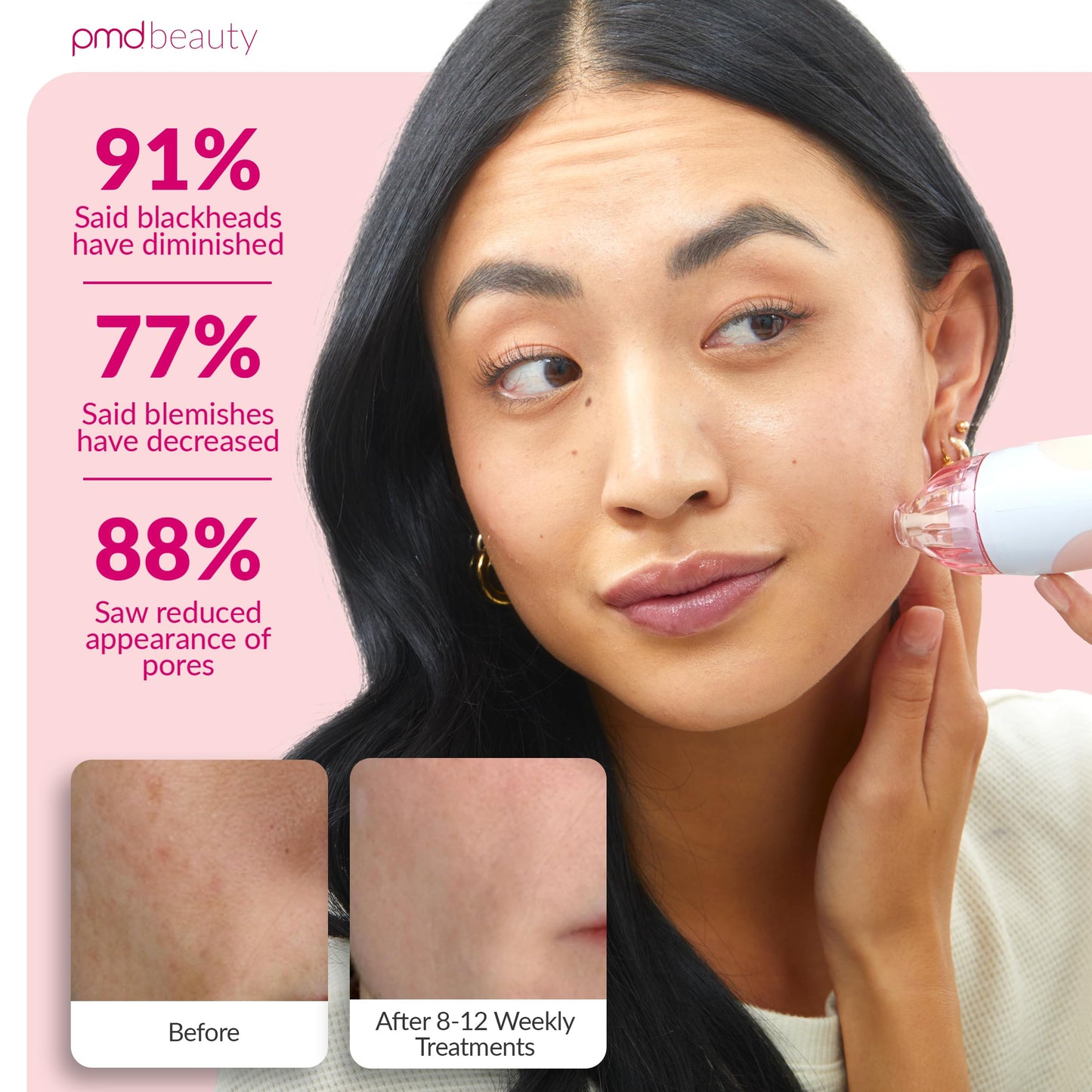 PMD Personal Microderm Classic for At-Home Use, Facial Exfoliator Tool, Microdermabrasion Machine Kit for Face and Body Skincare, Blush